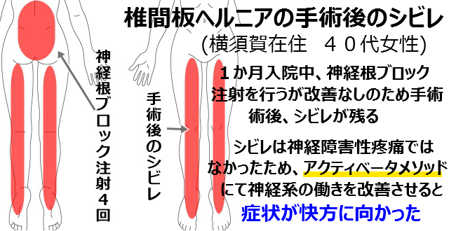 ヘルニア改善 ヘルニア改善